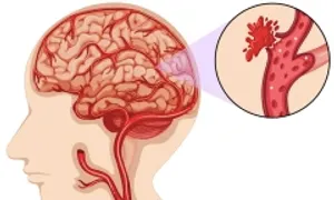 Huyết khối tĩnh mạch não khác đột quỵ thế nào